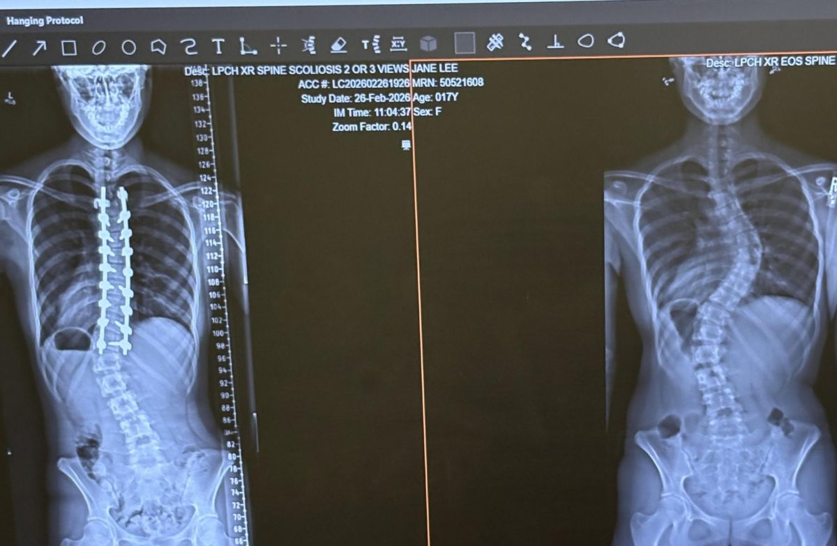 My spine six weeks post-fusion.